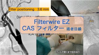 Filterwire EZ 頚動脈ステント(CAS) 用フィルタ の使い方 術者目線