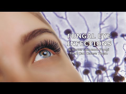 فنگل آنکھوں کے انفیکشن اور کچھ عام فنگس جو ان کا سبب بن سکتے ہیں۔