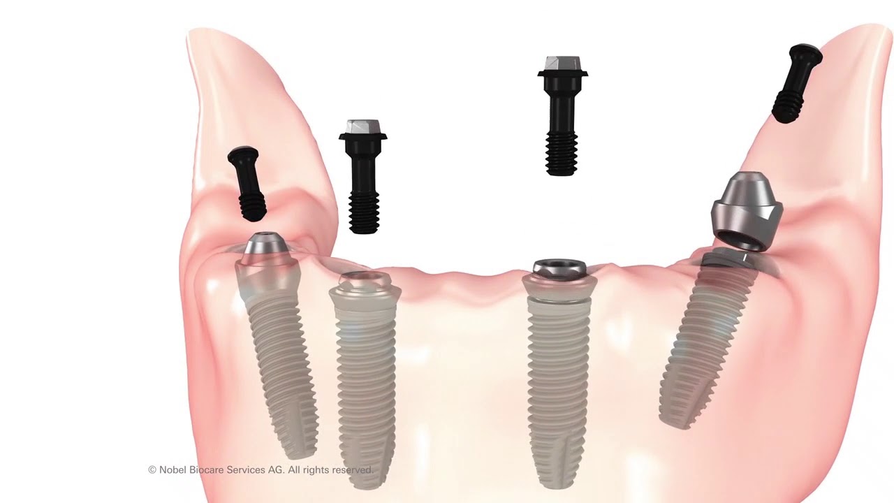 Se puede reparar una prótesis dental fija