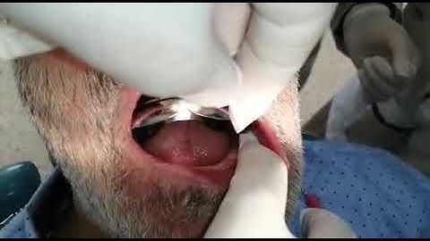 Visit 1: How to check the stock tray size in the lower arch