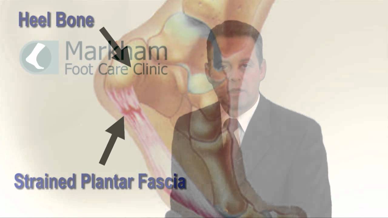 Heel Pain Treatment - Chiropodist in Markham, Unionville and Stouffville, ON