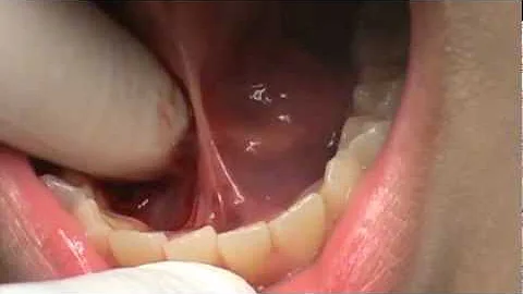 Tongue Tie Release with Laser Dr. Kenneth R. Levine South Florida/Broward County.mpg