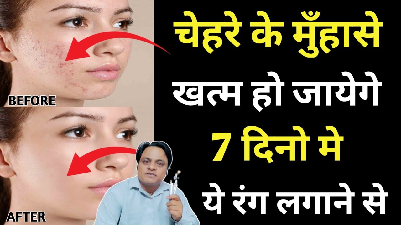 Colour Therapy For Pimples। Pimples Treatment At Home। Pimples Removal