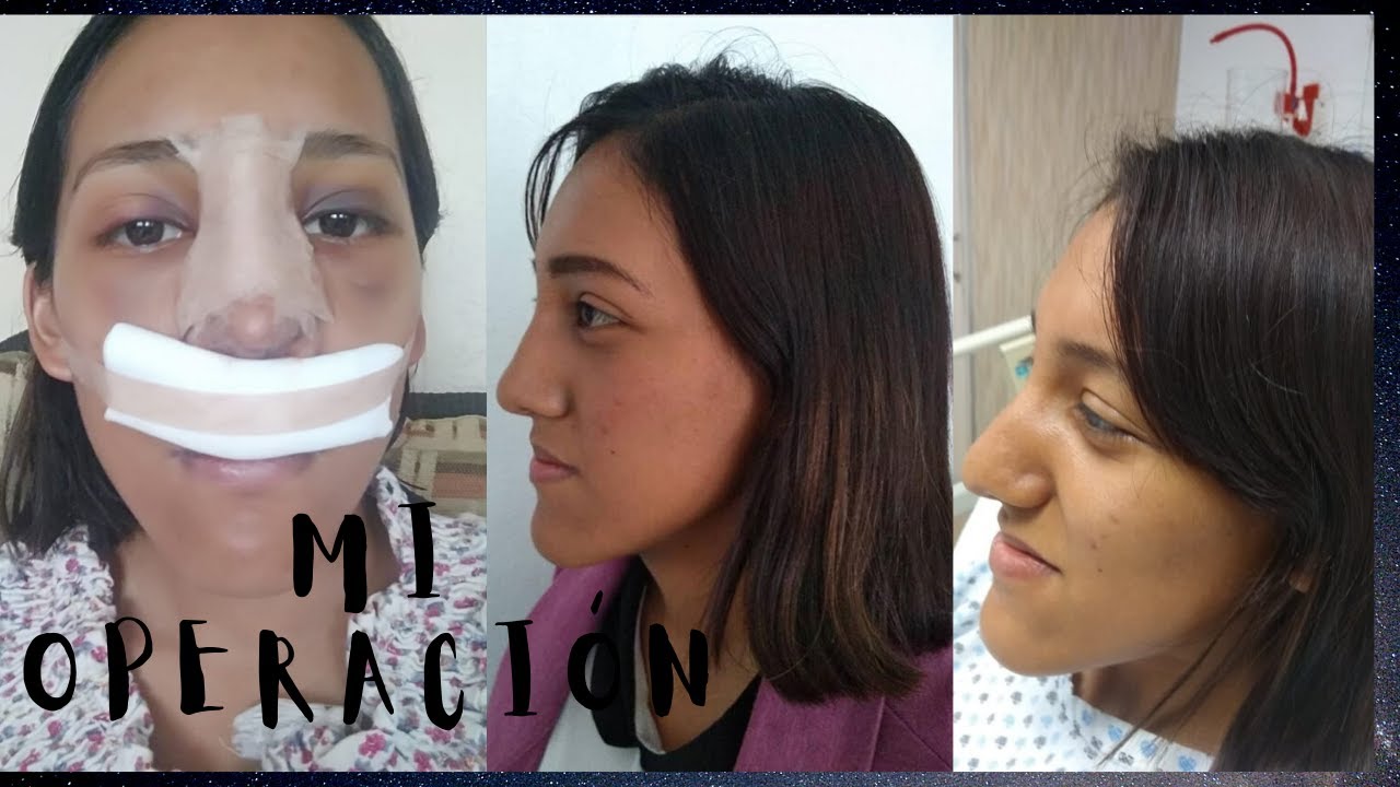 Me Quiero Operar La Nariz Me operé la nariz - YouTube