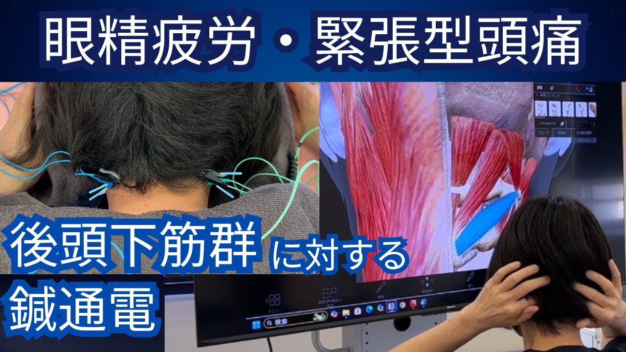 眼精疲労・緊張型頭痛 後頭下筋群に対する鍼通電