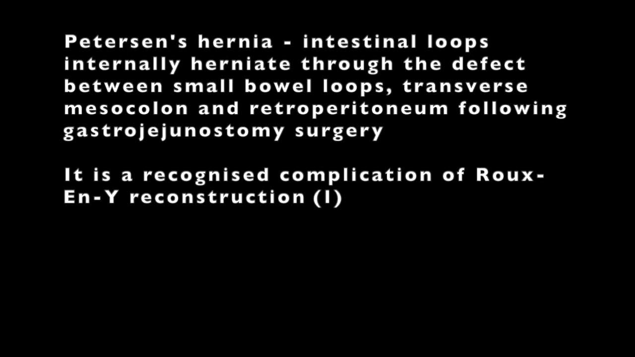 Internal Hernia Through Petersen’s Defect 13 Years Post Gastrectomy