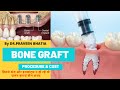 Need of BONE GRAFT ,its procedure & cost-किन स्तिथिओ में बोन  ग्राफ्ट की ज़रुरत पड़ती है,इसका खर्च-BDP