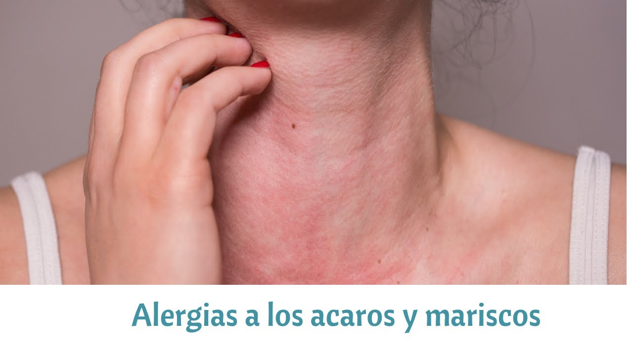 Reacción alérgica a mariscos