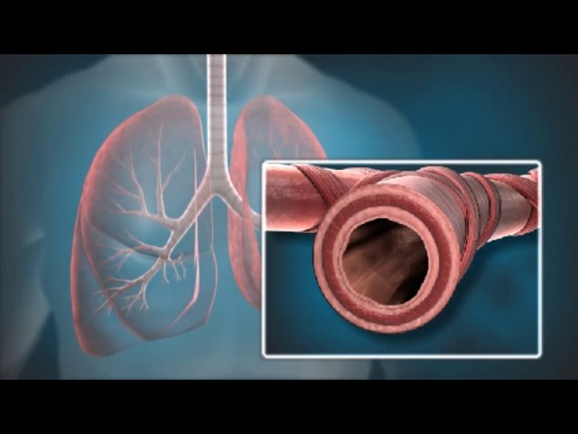 Watch Bronchial Thermoplasty Animation: How the Procedure Works on YouTube.