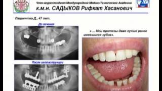 Протезирование зубов на имплантатах(Протезирование зубов на имплантатах с памятью формы в стоматологической клинике 