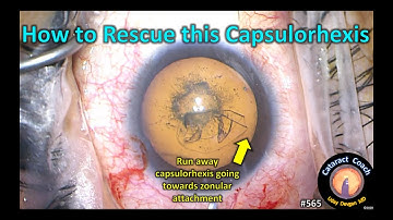 How to Rescue this Capsulorhexis during Cataract Surgery