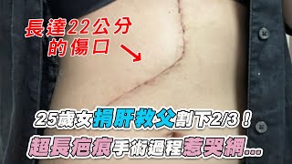 【25歲女捐肝救父割下2/3！  超長疤痕手術過程惹哭網...】｜@JESSICACHU