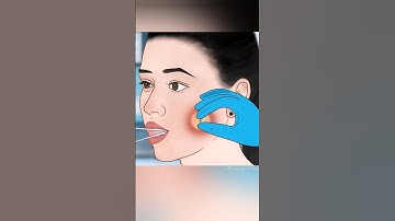 ASMR Remove Unmanaged Dimple Piercing Pus Cleaning#asmr #asmrcleaning #satisfying #animation