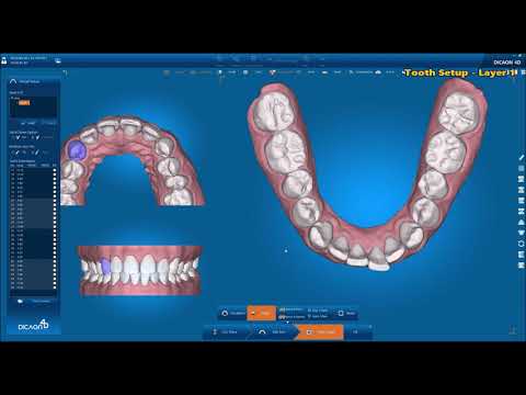 4.Virtual Setup ( Digital Orthodontic Software, DICAON 4D v1.6.1.0 )