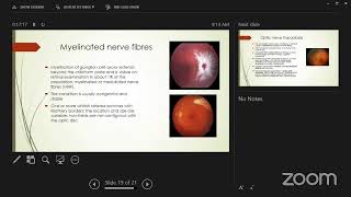 Disc abnormalities Dr Sourabh Patwardhan Nandadeep Eye Hospital's Personal Meeting Room