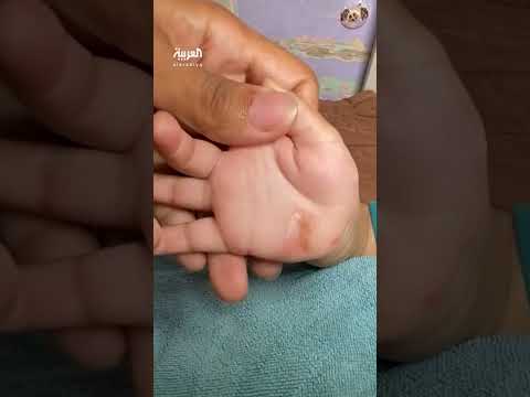 غزة: مقاومة البكتيريا للمضادات الحيوية تهدد الصحة العامة