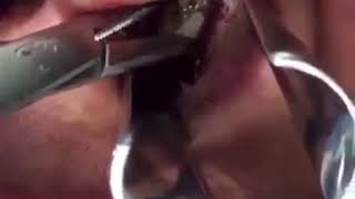 Dentist removes tooth from the nose