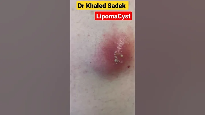 super hot infection #shorts #cystremoval #blackheads #pimplepopper Dr khaled sadek Lipomacyst.com