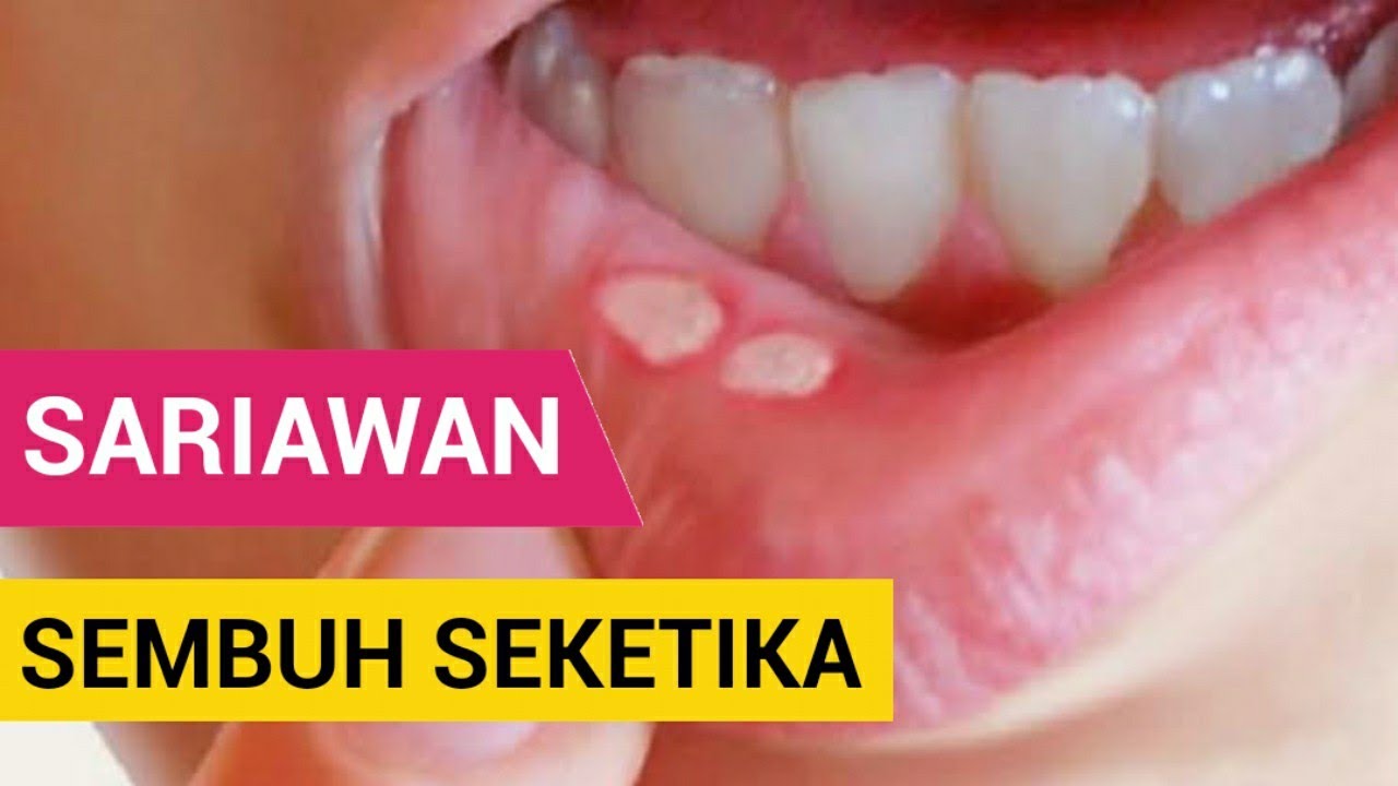 obat sariawan paling ampuh | obat sariawan | obat sariawan alami | cara