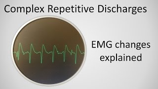 Complex Repetitive Discharges explained