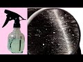 How to Treat Dandruff at Home | Get Rid of Dandruff Permanently