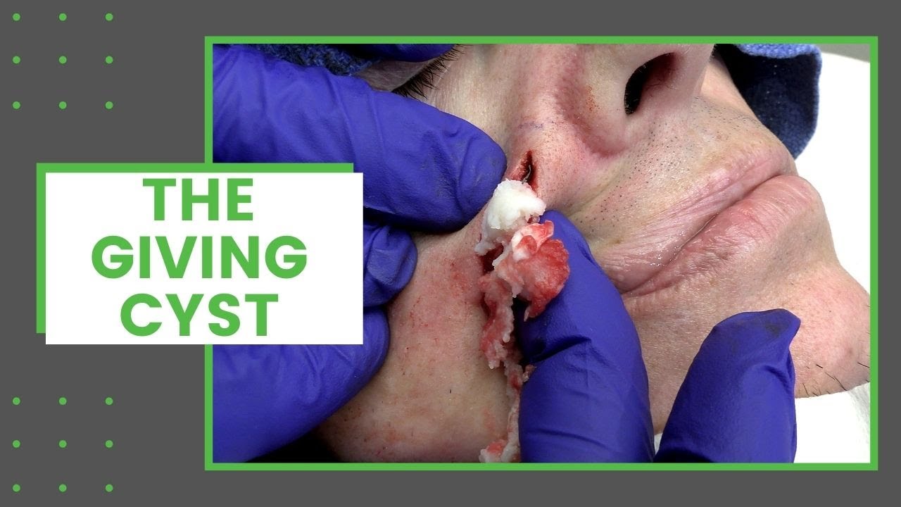 A really big cyst on the cheek