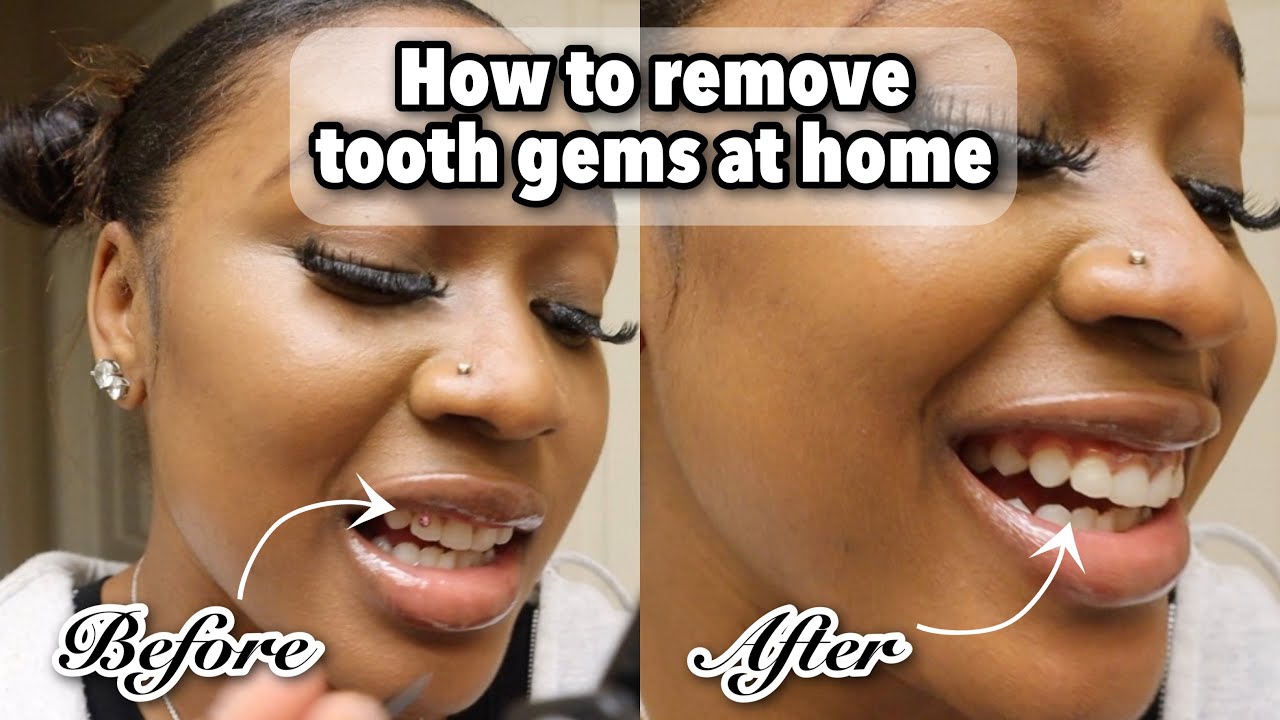 DIY Tooth Gem: How to remove a stubborn tooth gem at home 