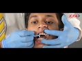 How to use orthodontic and interdental toothbrushes with braces