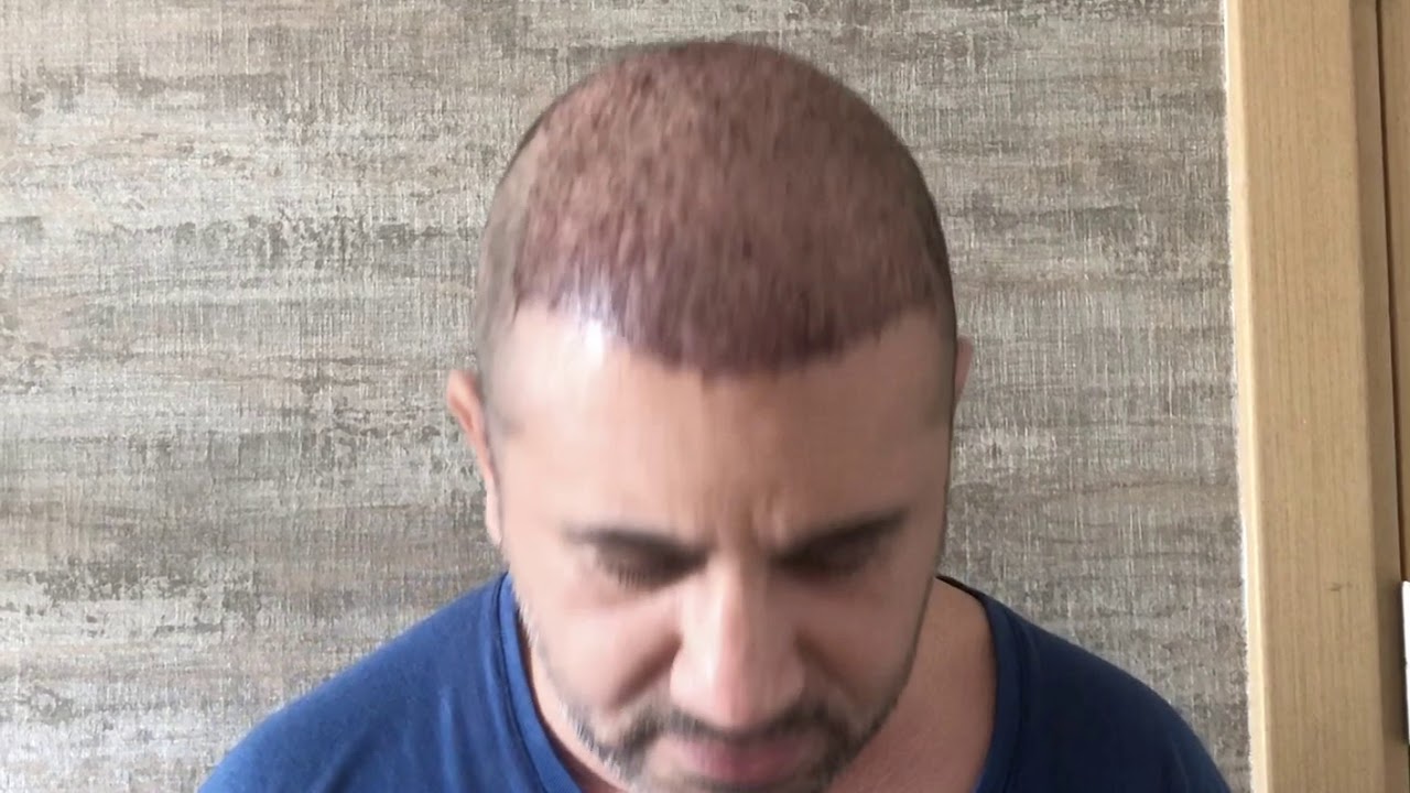 MY HAIR TRANSPLANT - Day 3 - YouTube