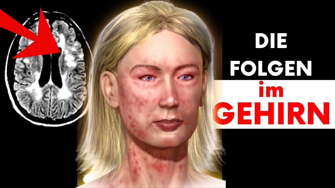 Multiple Sklerose: Arzt erklärt Entzündung, Symptome, Behandlung bei MS