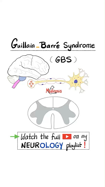 Guillain-Barré Syndrome (GBS) (acute inflammatory demyelinating polyradiculoneuropathy- AIDP)