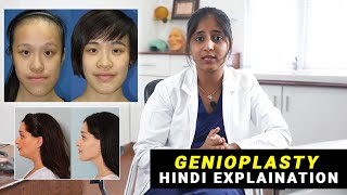 What is Genioplasty or Chin Surgery? Safe, Scarless, Simple Genioplasty in India