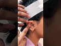 #OtoplastyInGurgaon by #DrRiteshAnand at #CentreForAesthetics
