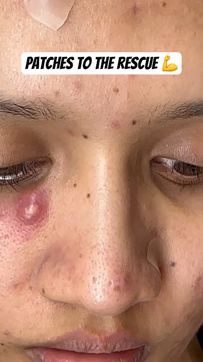 Patches to the rescue 💪 #acne #acnetreatment #cystic #cystpoping #acnepatch #pimplepatch #acnescars