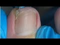 Huge sharp toenail Serious tingling foot