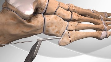 Metatarsal Fracture Repair with Arthrex® Jones Screw