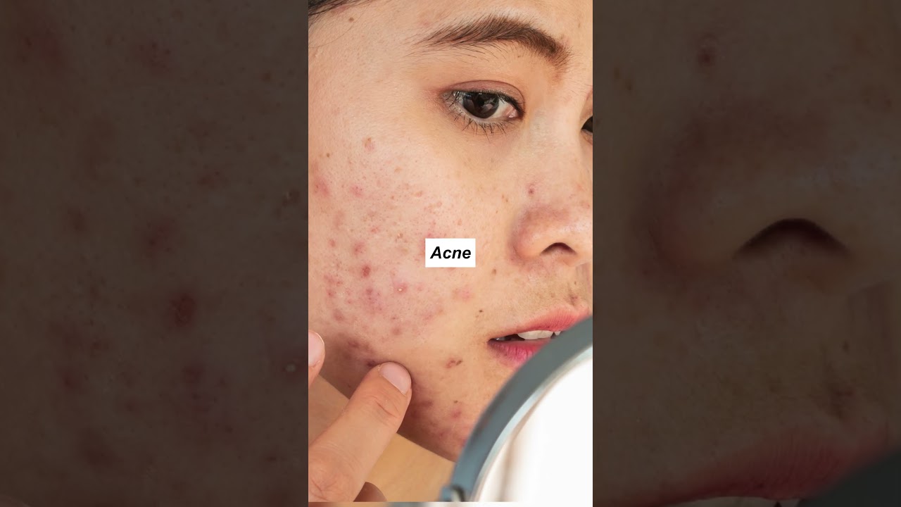 Aziderm Cream | Azelaic Acid Benefits 🌱 