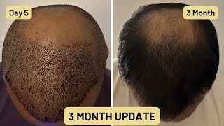 3 Month Update for Hair Transplant | 5200 grafts from Istanbul Turkey