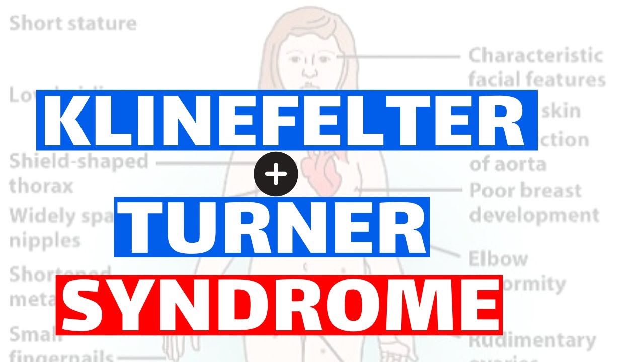 Klinefelter And Turner Syndrome Pathology Clinical Features Diagnosis