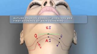 iGuide 2.0 Necklift Technology
