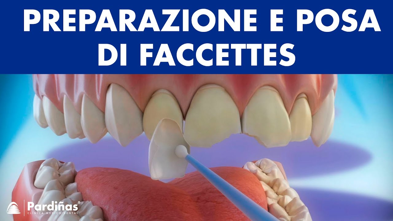 Faccette dentali - Preparazione e posa di faccettes ©