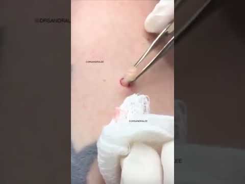 Does this cyst give you Deja Vu? 🥊 | Dr. Pimple Popper #shorts #drpimplepopper