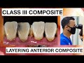 Step by step class iii composite restoration  dentist griya rr