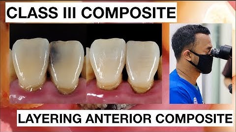 Step by Step Class III Composite Restoration | Dentist Griya RR