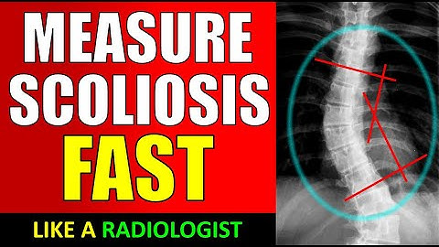 How to Measure a Scoliotic Curve 🩻#doctor #health #medical