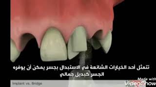 ماهو الفرق بين زراعه الاسنان وتركيب جسور خزفية؟