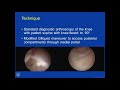 Dualposteromedial portal technique for complex arthroscopy in the posterior knee