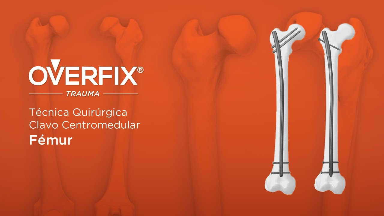 Técnica Quirúrgica Clavo Centromedular de Fémur OVERFIX