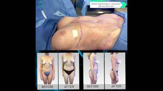 Exclusive 😍Amazing Breast Augmentation Before & After 😍Lipo 360 and Skin Tightening Renuvion Result 😍 Dr.Moein Profile