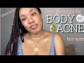 The BEST and most EFFECTIVE skin care products to get rid of BODY ACNE fast!| No more body acne💫